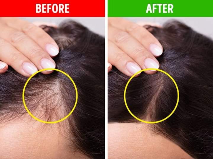 طرق زراعة الشعر التكلفة الطرق الأضرار هل زراعة الشعر دائمة