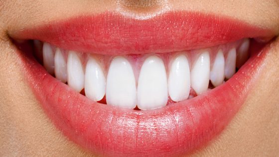 اضرار ابتسامة هوليود عدسات الاسنان المتحركة