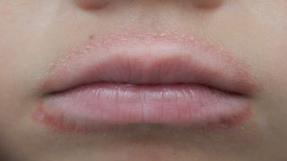 الاكزيما حول الفم الأسباب والاعراض والعلاج بالليزر نهاىيا