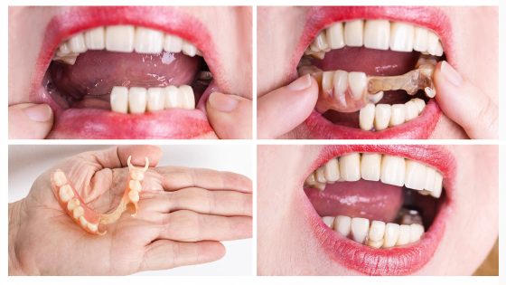 تركيب الأسنان المتحركة الأنواع والتكلفة وأهم المراكز لتركيبها