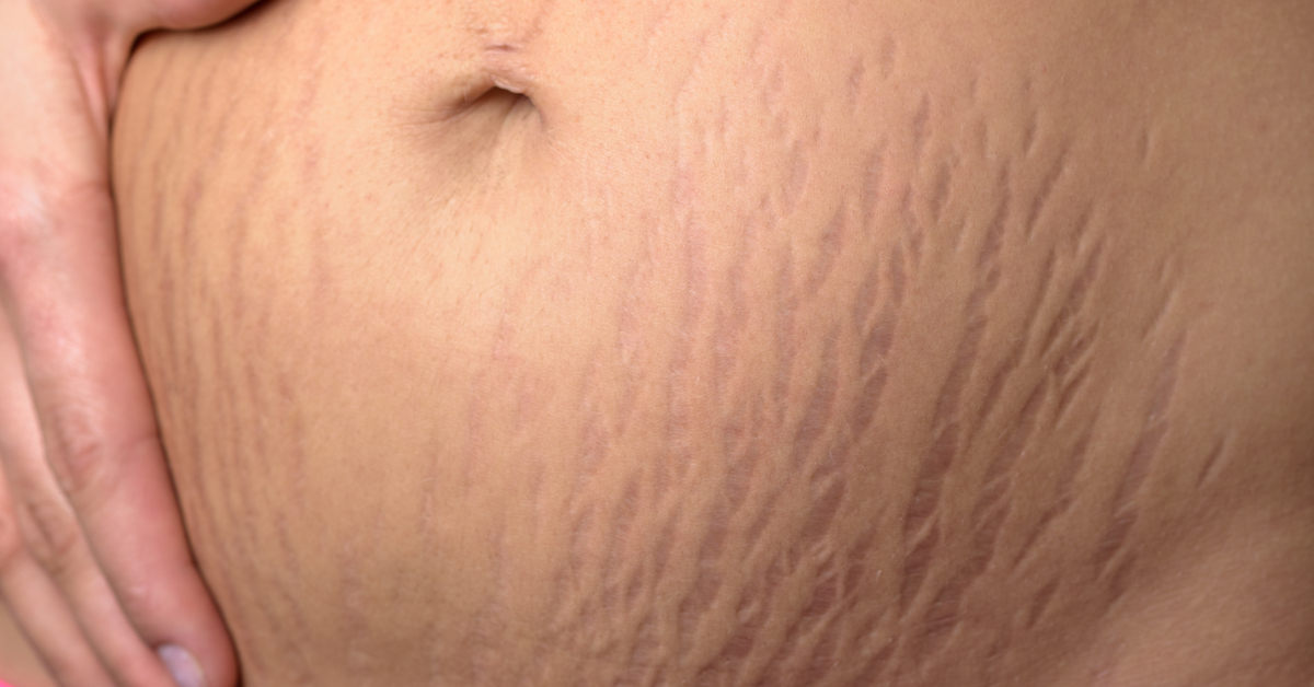 علاج تشققات البطن الليزر الكربوني والوخز بالإبر