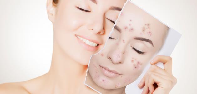 إزالة آثار الحبوب الأسباب طرق العلاج كريم وخلطة ماسك لإزالة آثار الحبوب