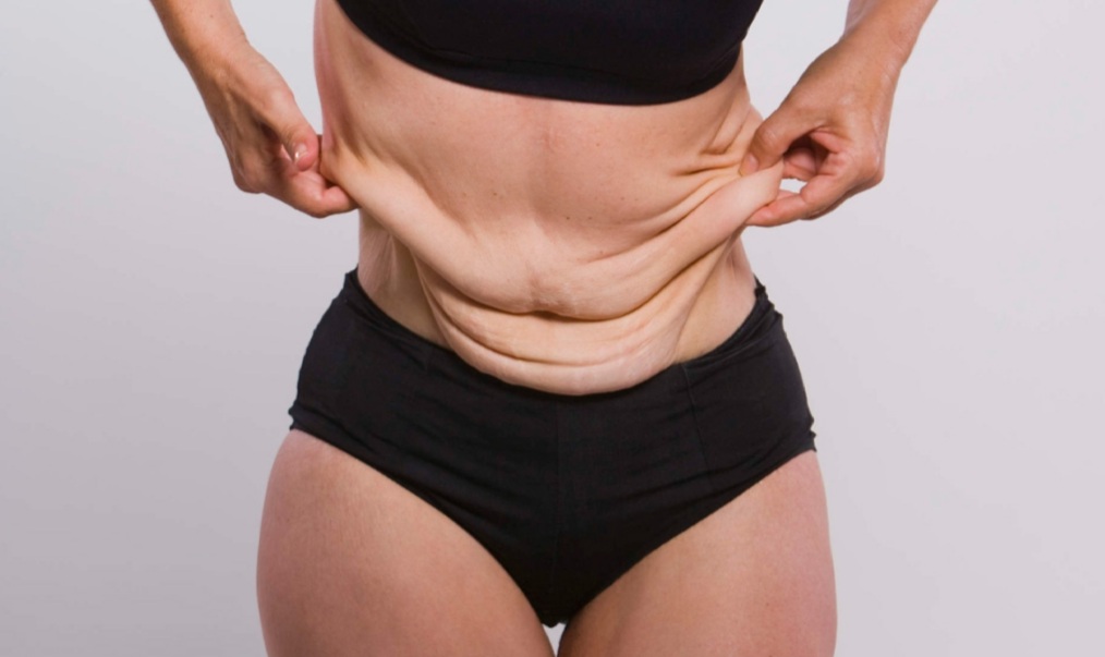 10 نصائح لشد الجسم بعد التنحيف