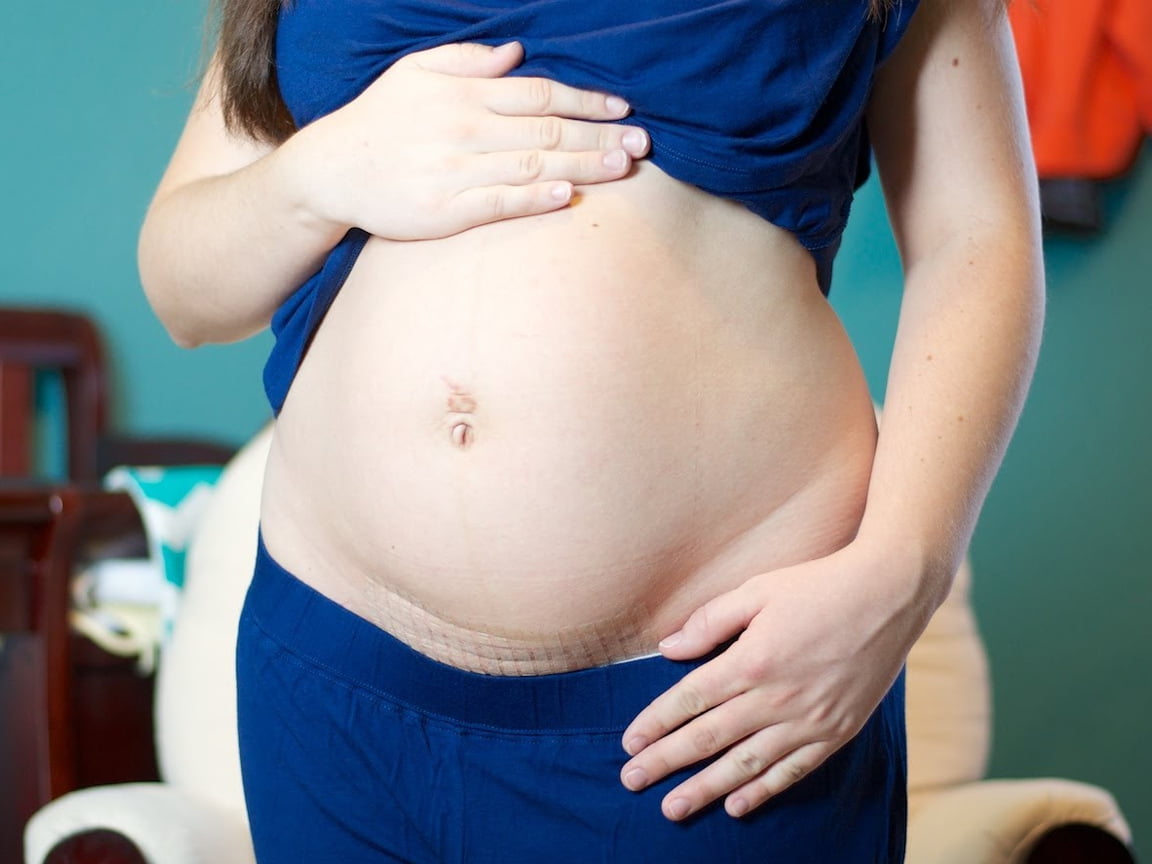 الحمل الثاني بعد العملية القيصرية خطورة الحمل بعد العملية القيصرية