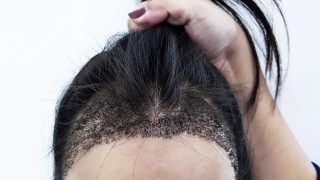 عملية زراعة الشعر التكلفة والنتائج