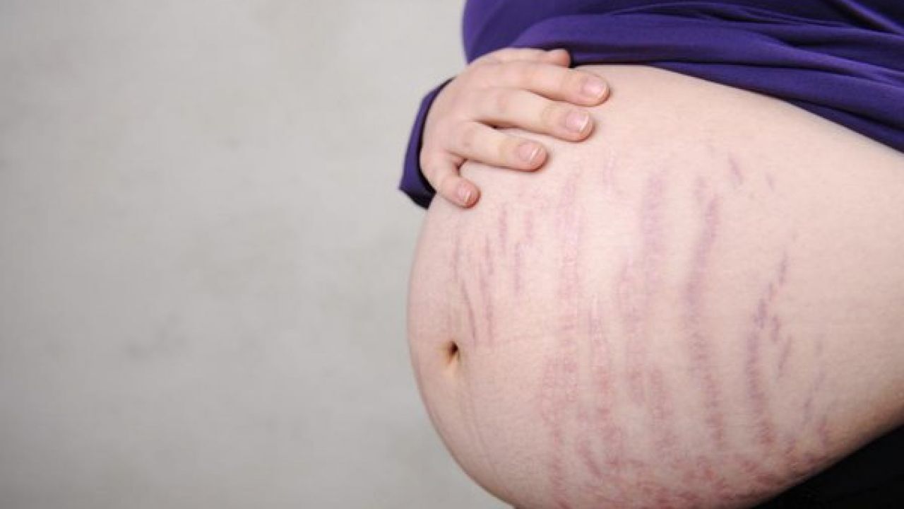 علاج تشققات البطن بعد الولادة القيصرية