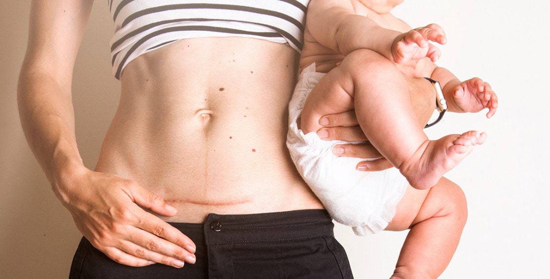 هل العملية القيصرية الثالثة تكون نفس مكان الأولى