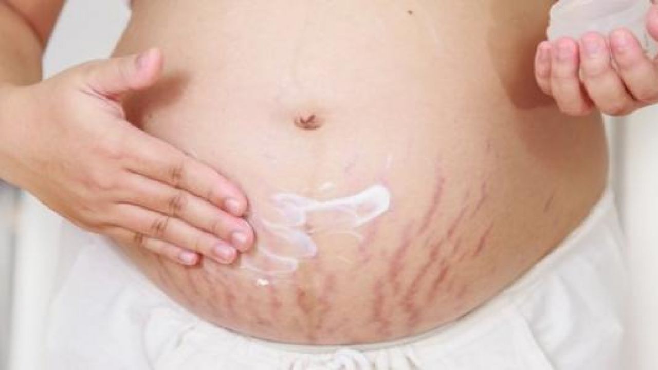 طرق علاج آثار تمدد البطن بعد الولادة بزيت الزيتون والجلسرين