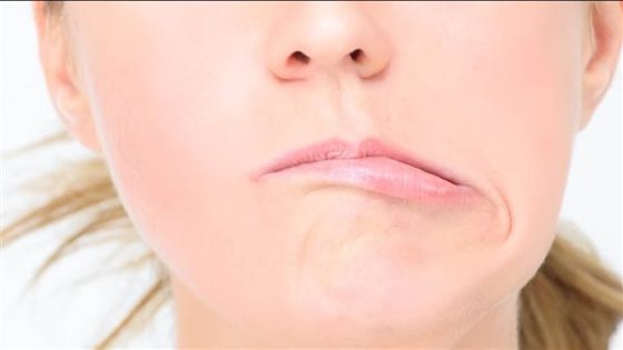 أعراض وعلاج التهاب العصب السابع، أهمها تدلي الوجه