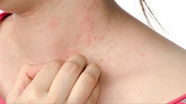 أعراض الجرب، وهل يمكن أن ينتقل من الحيوانات الأليفة إلى الإنسان؟