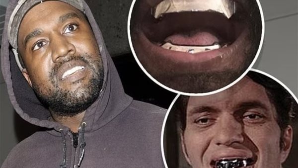 كانييه ويست يخلع جميع أسنانه ويستبدل بها طقما معدنيا بقيمة 850 ألف دولار (صور)