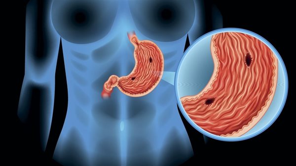 علاج قرحة المعدة بالوصفات الطبيعية، وطرق الوقاية