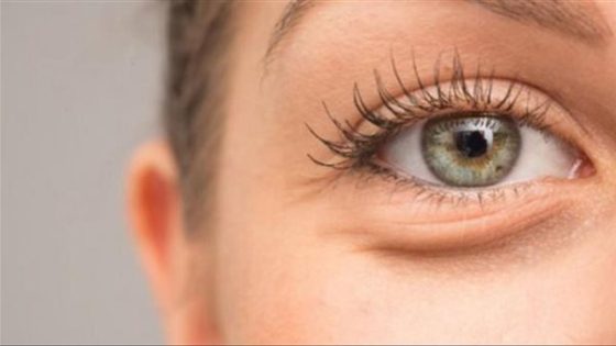 انتفاخات تحت العين، الأسباب الأعراض وطرق العلاج