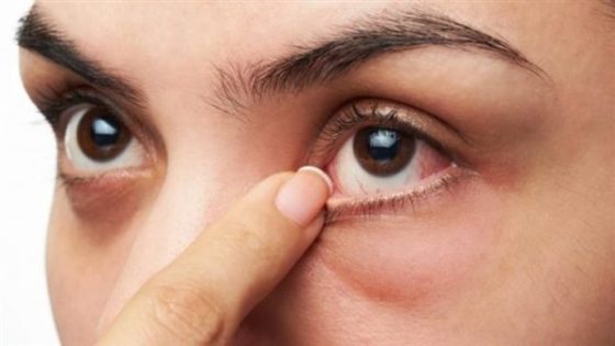 7 طرق منزلية لعلاج تورم العين للأطفال والبالغين