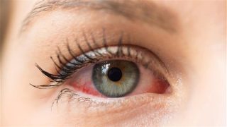أسباب احمرار العين وأعراض الحساسية والجلوكوما