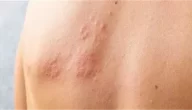 أسباب الإصابة بالهربس النطاقي، وتأثيره على الحمل والرضاعة